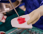 Biopsia de la próstata - evitada con Uroprostan